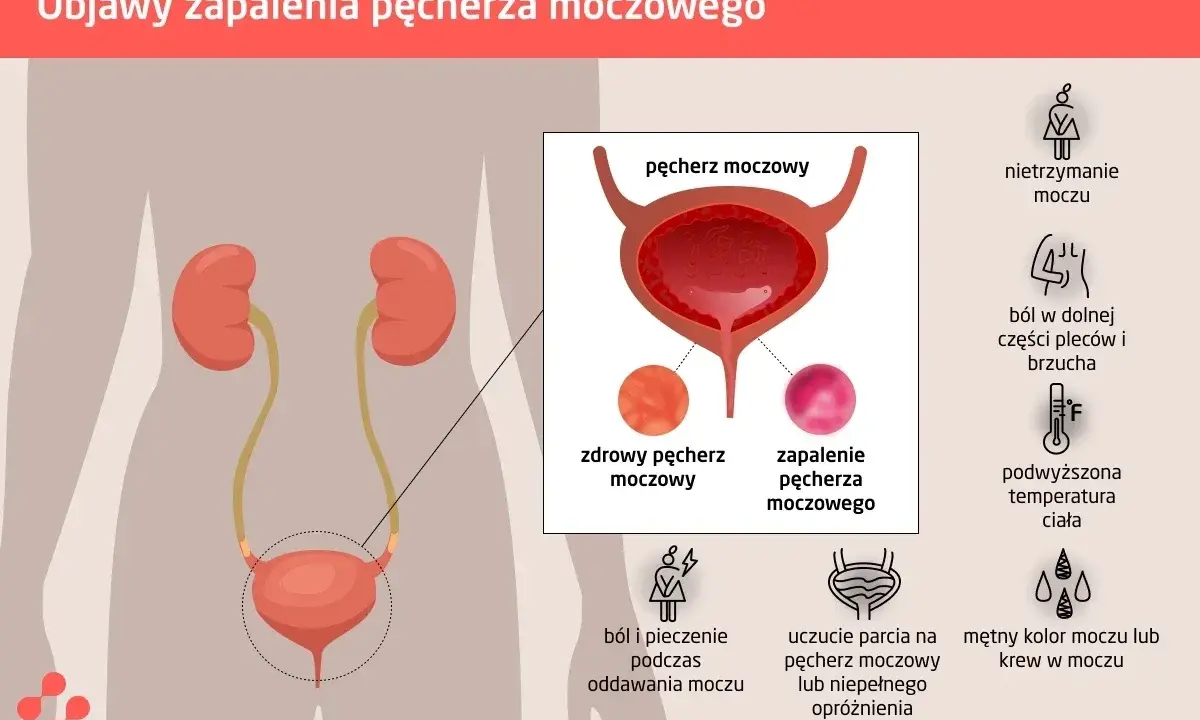 Ból w dole brzucha i ucisk na pęcherz to objawy zapalenia. Ilustracja pokazuje układ moczowy i symptomy infekcji.