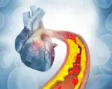 Nattokinaza na co pomaga? Obraz przedstawia serce i zatkane miażdżycą naczynia krwionośne z cholesterolem.
