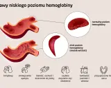 Objawy niskiej hemoglobiny: ból głowy, bladość, zmęczenie. Co jeść, by podnieść poziom? Ilustracja pokazuje zdrowe i chore krwinki.