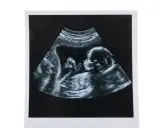 USG w 12 tygodniu ciąży pokazuje profil dziecka. To ważny etap, jak wyglądają badania prenatalne.