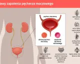 Ból w dole brzucha i ucisk na pęcherz to objawy zapalenia. Ilustracja pokazuje układ moczowy i symptomy infekcji.