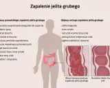 Ilustracja przedstawia objawy zapalenia jelita grubego, w tym wrzodziejące zapalenie jelita grubego. Pokazuje zmiany w błonie śluzowej jelita.
