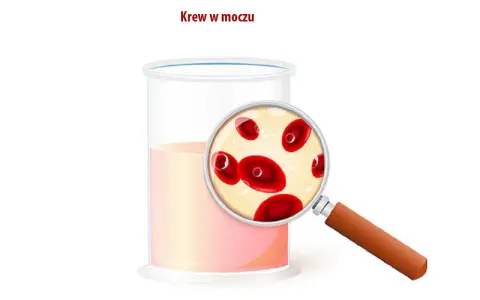 Szklanka z płynem i szkło powiększające ukazujące czerwone krwinki. Obrazek ilustruje krew w moczu.