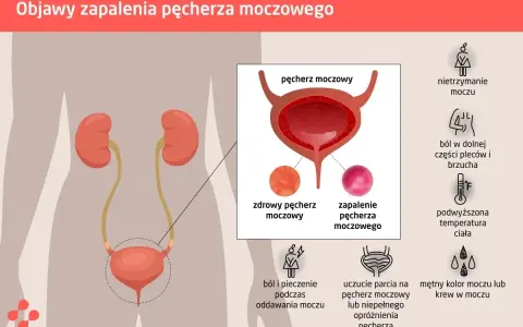 Ból w dole brzucha i ucisk na pęcherz to objawy zapalenia. Ilustracja pokazuje układ moczowy i symptomy infekcji.