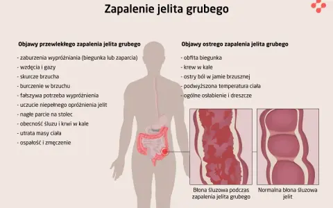 Ilustracja przedstawia objawy zapalenia jelita grubego, w tym wrzodziejące zapalenie jelita grubego. Pokazuje zmiany w błonie śluzowej jelita.