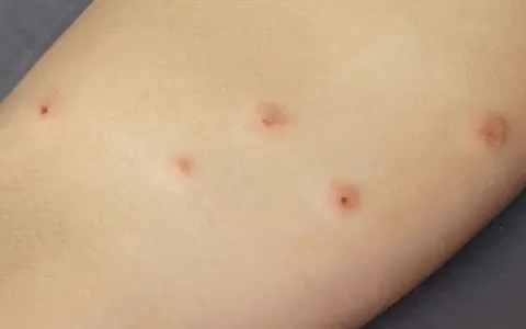 Kilka czerwonych, swędzących śladów na skórze, przypominających pojedyncze ugryzienie pluskwy.
