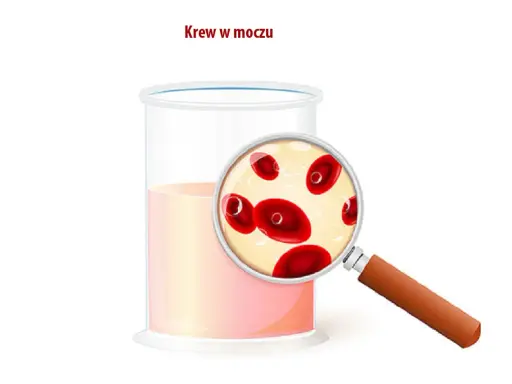 Szklanka z płynem i szkło powiększające ukazujące czerwone krwinki. Obrazek ilustruje krew w moczu.