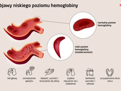 Objawy niskiej hemoglobiny: ból głowy, bladość, zmęczenie. Co jeść, by podnieść poziom? Ilustracja pokazuje zdrowe i chore krwinki.