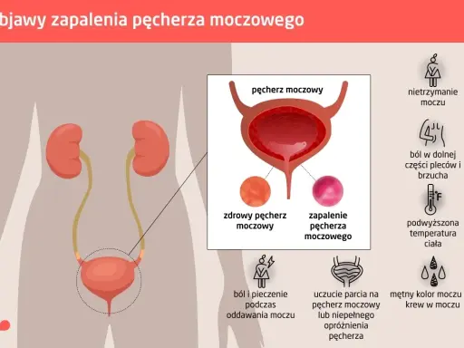 Ból w dole brzucha i ucisk na pęcherz to objawy zapalenia. Ilustracja pokazuje układ moczowy i symptomy infekcji.
