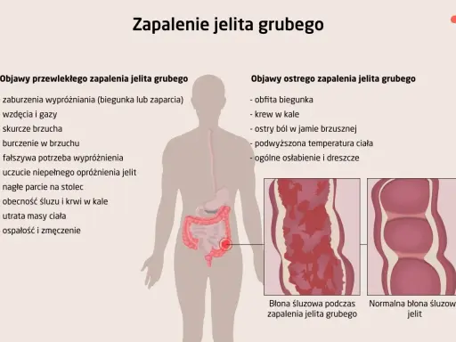 Ilustracja przedstawia objawy zapalenia jelita grubego, w tym wrzodziejące zapalenie jelita grubego. Pokazuje zmiany w błonie śluzowej jelita.