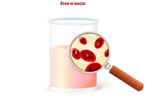 Szklanka z płynem i szkło powiększające ukazujące czerwone krwinki. Obrazek ilustruje krew w moczu.
