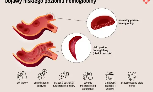Objawy niskiej hemoglobiny: ból głowy, bladość, zmęczenie. Co jeść, by podnieść poziom? Ilustracja pokazuje zdrowe i chore krwinki.