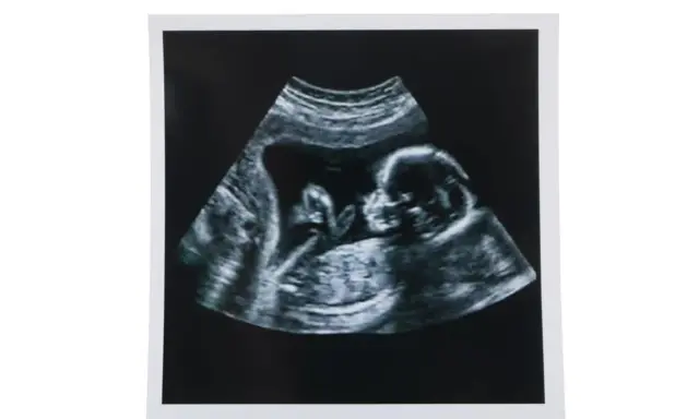 USG w 12 tygodniu ciąży pokazuje profil dziecka. To ważny etap, jak wyglądają badania prenatalne.