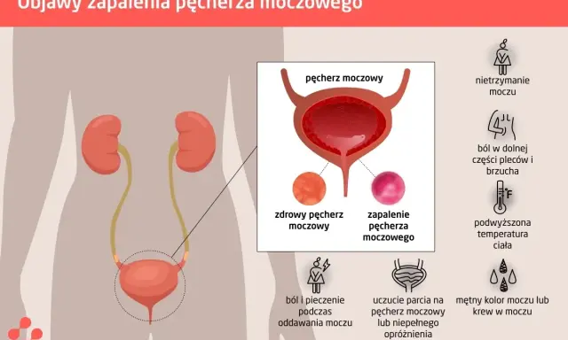 Ból w dole brzucha i ucisk na pęcherz to objawy zapalenia. Ilustracja pokazuje układ moczowy i symptomy infekcji.