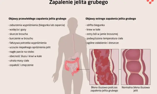 Ilustracja przedstawia objawy zapalenia jelita grubego, w tym wrzodziejące zapalenie jelita grubego. Pokazuje zmiany w błonie śluzowej jelita.
