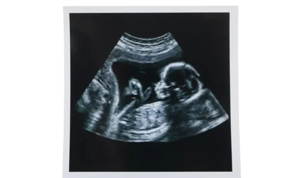 USG w 12 tygodniu ciąży pokazuje profil dziecka. To ważny etap, jak wyglądają badania prenatalne.