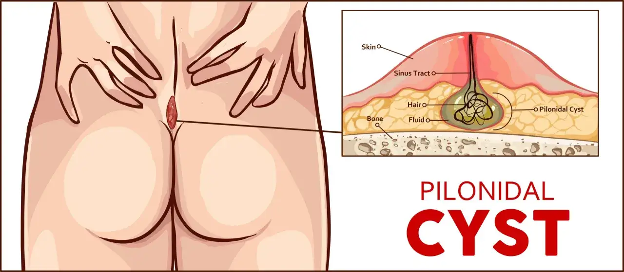 Ilustracja pokazuje wrz&oacute;d na dupie, czyli torbiel pilonidalną, z przekrojem ukazującym włosy i płyn wewnątrz.