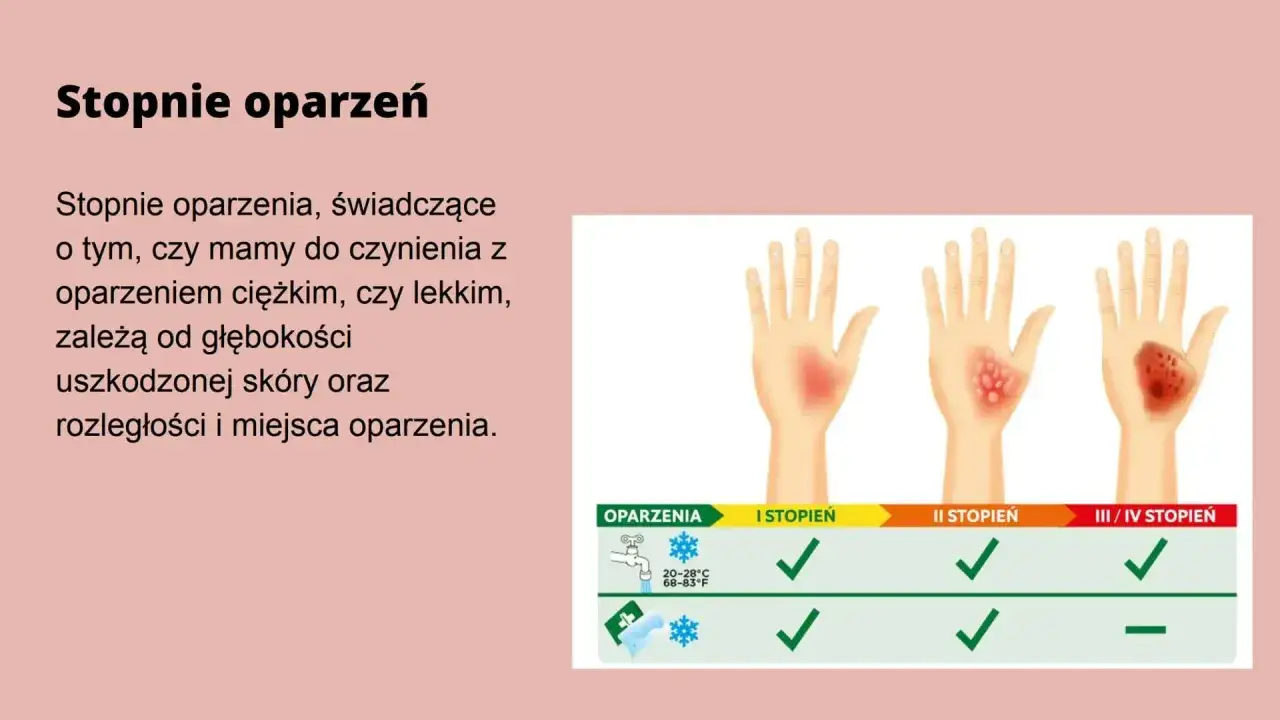 Ilustracja pokazuje dłonie z oparzeniami I, II i III/IV stopnia. Najpoważniejsze oparzenie 4 stopnia jest widoczne na ostatniej dłoni.