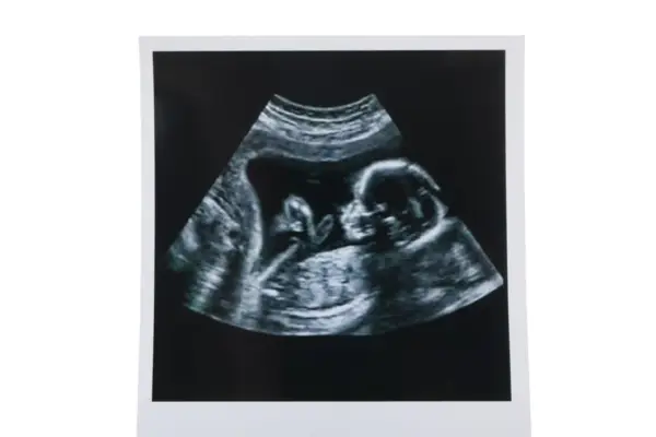 USG w 12 tygodniu ciąży pokazuje profil dziecka. To ważny etap, jak wyglądają badania prenatalne.