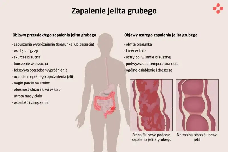 Ilustracja przedstawia objawy zapalenia jelita grubego, w tym wrzodziejące zapalenie jelita grubego. Pokazuje zmiany w błonie śluzowej jelita.
